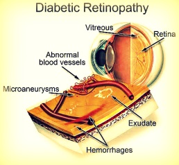 Diabetic Eye Disease Month